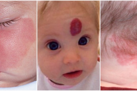 Semnele din naștere roșii și pigmentate. Care sunt cele periculoase și necesită tratament?