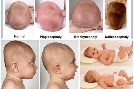 Sindromul plagiocefaliei (capul turtit la bebeluși)