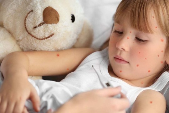 16 copii din Ceadîr-Lunga s-au îmbolnăvit de rujeolă. Unul dintre ei era vaccinat