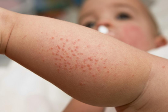Medic pediatru-alergolog: Copilul poate avea un șoc anafilactic de la pește sau arahide chiar dacă nu le-a consumat