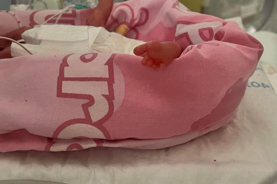 Cel mai mic bebeluș prematur din Marea Britanie a supraviețuit, spre mirarea medicilor