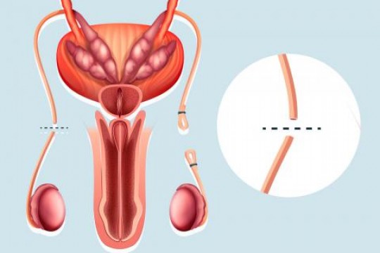 Medic obstetrician-ginecolog despre vasectomie: Această metodă de sterilizare definitivă a bărbatului nu afectează nivelul de testosteron
