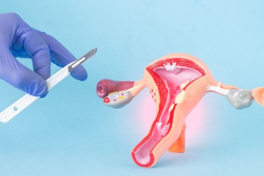 Medic chirurg ginecolog: 5 riscuri la care te supui dacă apelezi la embolizarea arterelor uterine și fibromul uterin