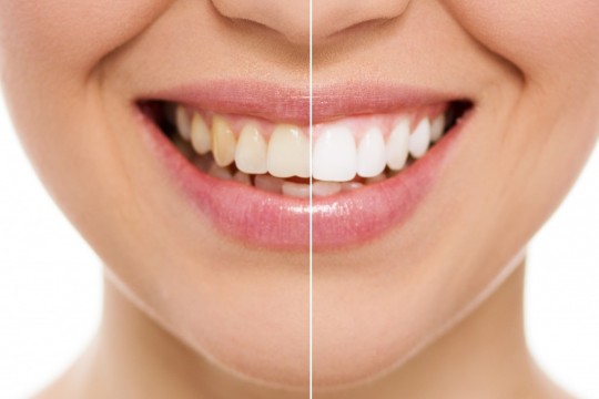 Clătitul gurii cu ulei: dinți mai albi, mai sănătoși și organism fără toxine