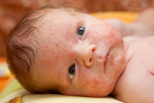 Cele mai întâlnite afecțiuni ale pielii la bebeluși – prevenție și tratament