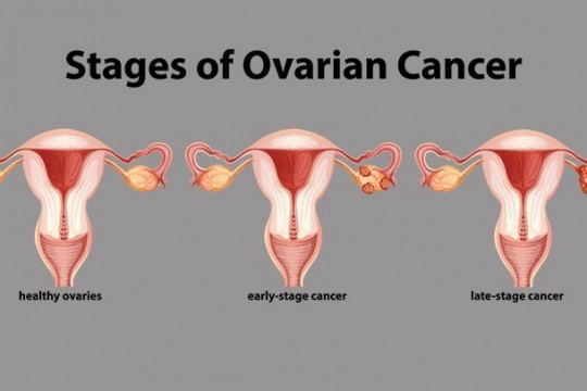 7 simptome ale cancerului ovarian
