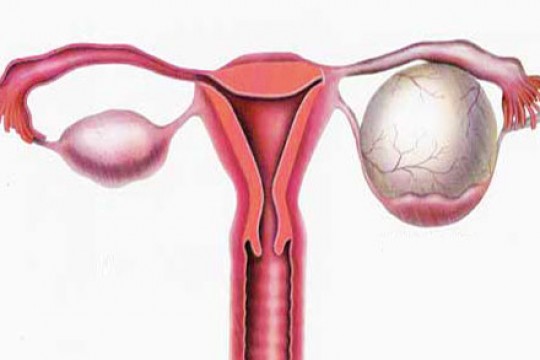 Chisturile ovariene: 13 mituri spulberate de medicul ginecolog