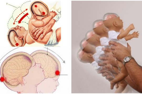 Medic neonatolog: Se atestă o creștere a cazurilor de sindrom al copilului zgâlțâit